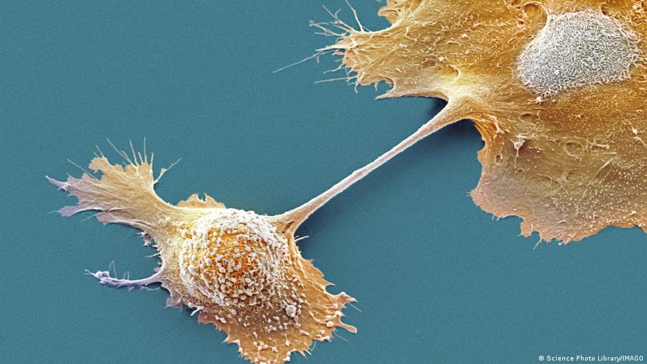 Novo medicamento promete prolongar vida de pacientes com câncer de pâncreas